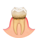 歯と歯肉の間に歯垢がたまります
