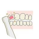 歯のクリーニングと自宅での使用法説明